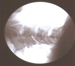 Bloqueo de articulación interapofisaria y ramo medial cervical