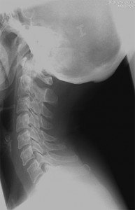 Bloqueo-de-articulación-interapofisaria-y-ramo-medial-cervical_1