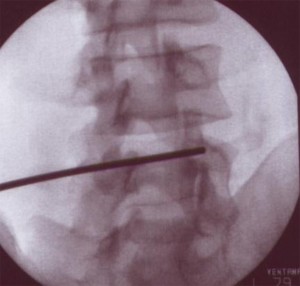 Bloqueo-de-articulación-interapofisaria-y-ramo-medial-lumbar_1