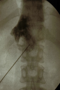 Bloqueo-del-ganglio-celíaco_1