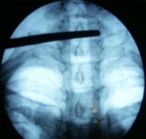 Bloqueo-del-ganglio-estrellado_1