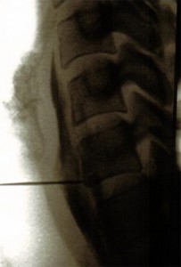 Bloqueo-del-ganglio-estrellado_3