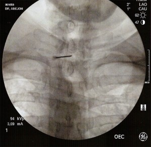 Bloqueo-epidural-cervical_1
