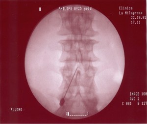 Bloqueo-epidural-lumbar_1