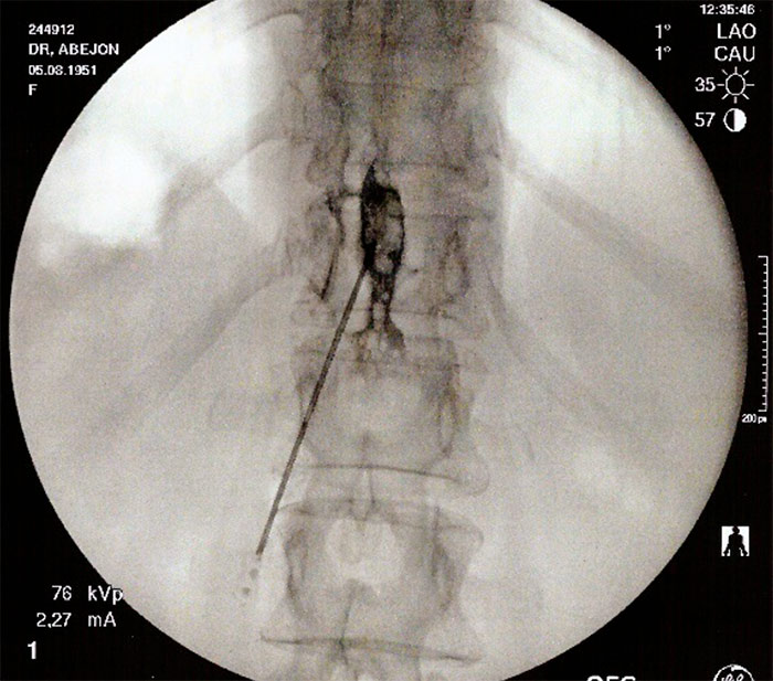Bloqueo-epidural-torácico