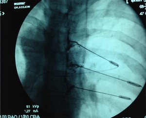 Bloqueo transforaminal torácico_1